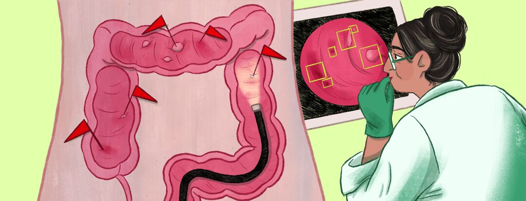 Navigating a Colonoscopy: A Step-by-Step Experience image